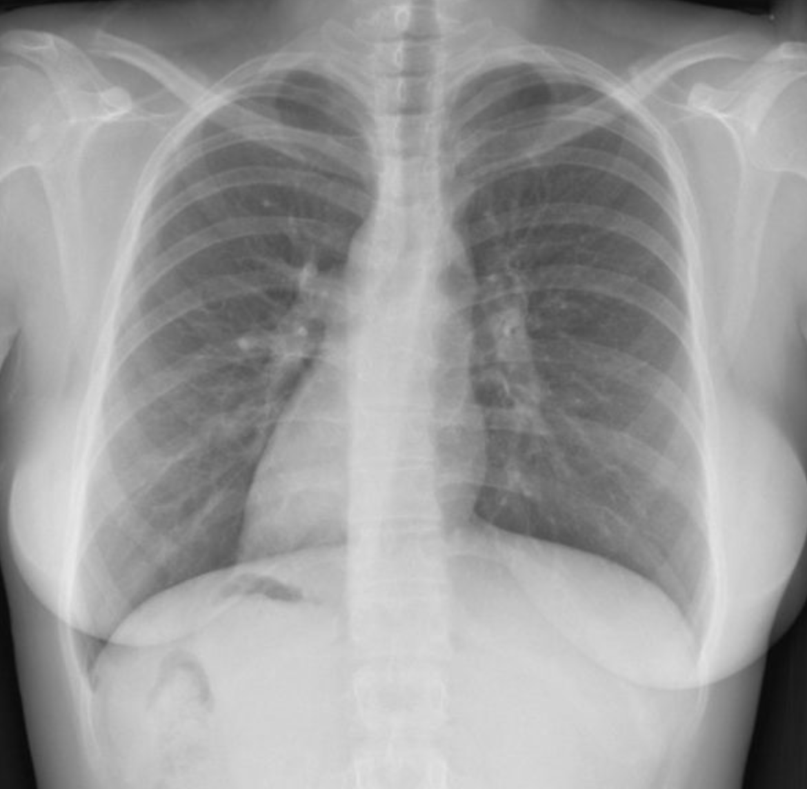 A chest x-ray of a personDescription automatically generated