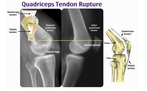A close-up of a x-ray of a kneeDescription automatically generated