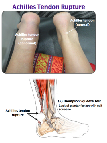 A diagram of a foot and ankleDescription automatically generated