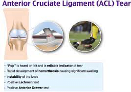 A diagram of a knee injuryDescription automatically generated