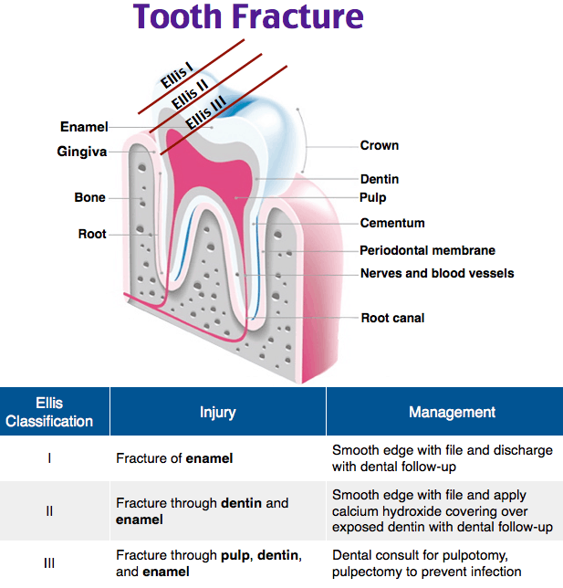 A diagram of a toothDescription automatically generated