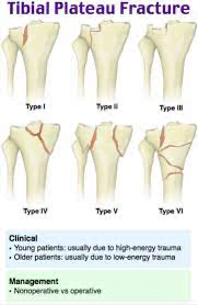 A diagram of bones showing different types of injuriesDescription automatically generated with medium confidence