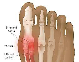 A foot with bones and bones highlightedDescription automatically generated with medium confidence