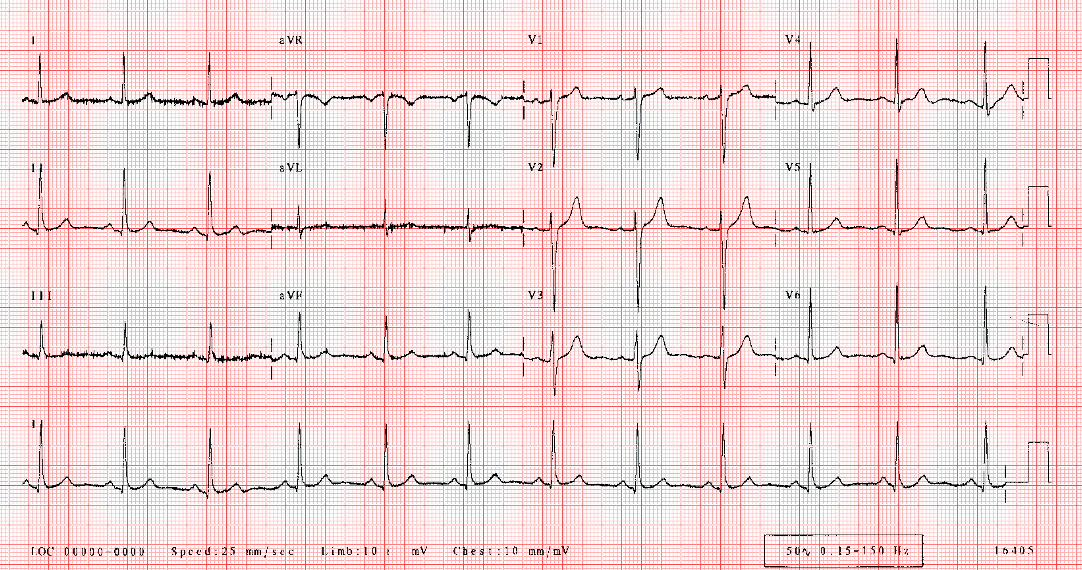 A graph of a heart rateDescription automatically generated