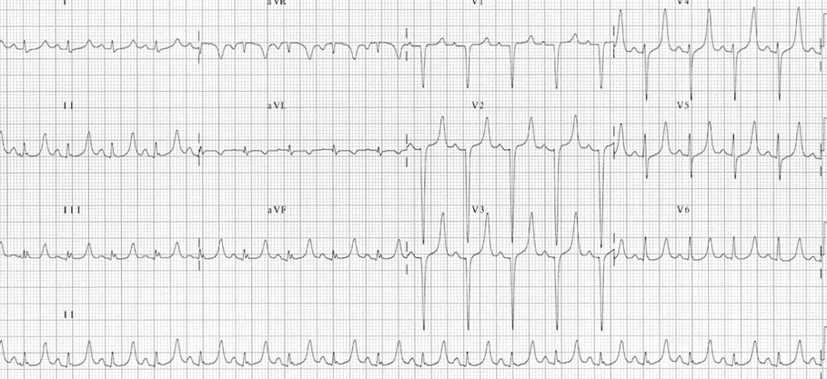 A graph of a heart rateDescription automatically generated