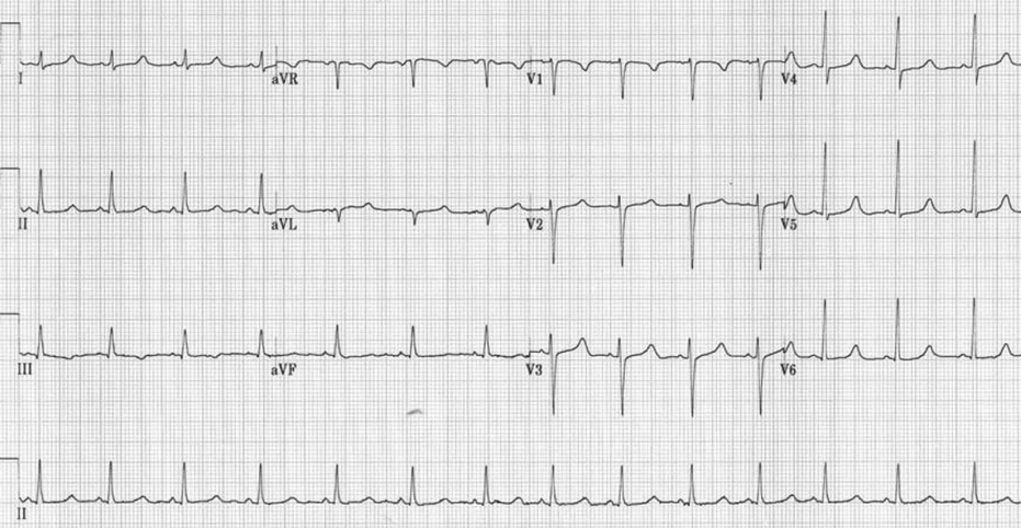 A graph of a heart rateDescription automatically generated