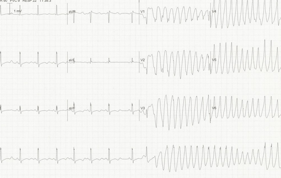 A graph of a heart rateDescription automatically generated