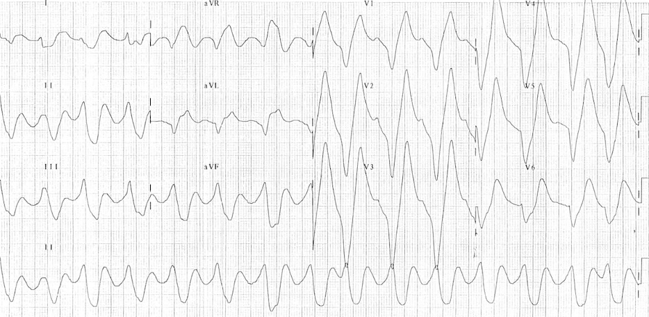 A graph of a heart rateDescription automatically generated