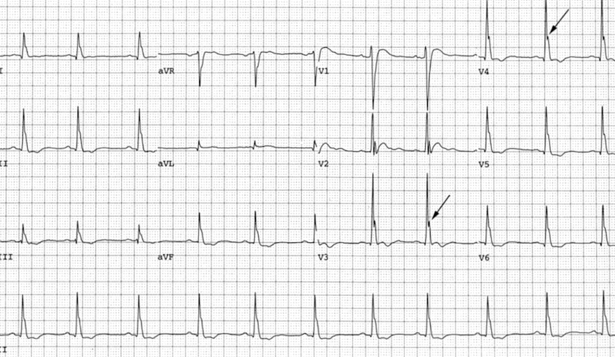 A graph of a heart rateDescription automatically generated