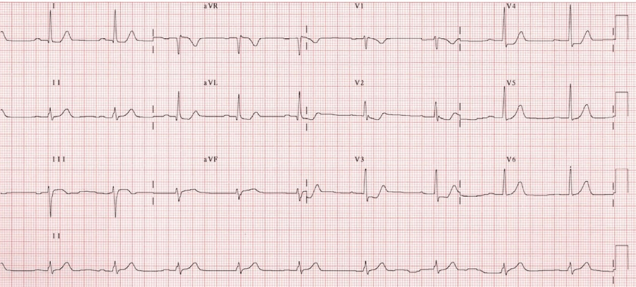 A graph of a heart rateDescription automatically generated