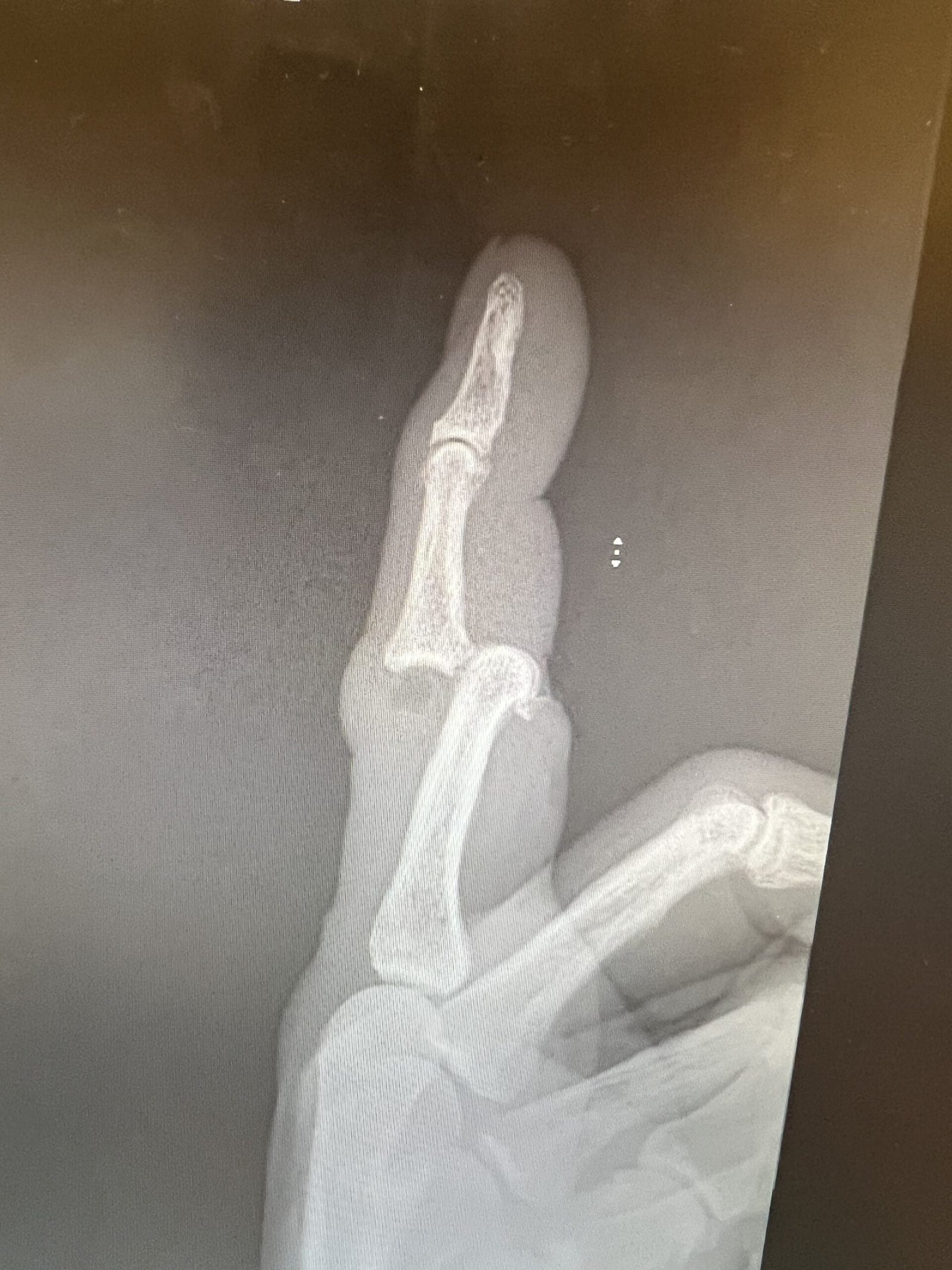 A x-ray of a handDescription automatically generated