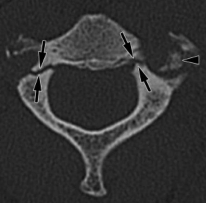 An x-ray of a femurDescription automatically generated