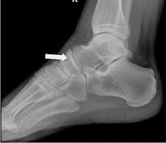 An x-ray of a footDescription automatically generated