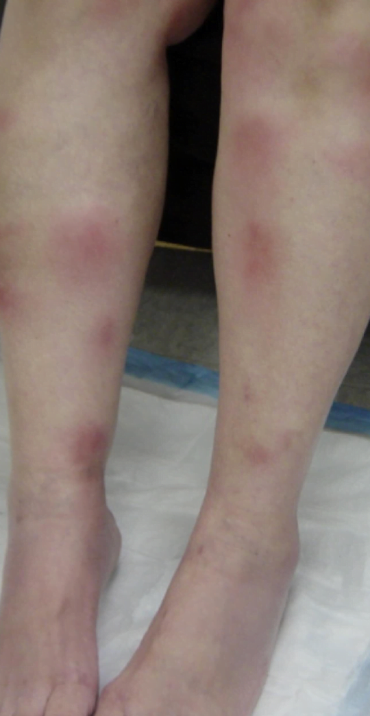 Close-up of a person's legs with red bumpsDescription automatically generated
