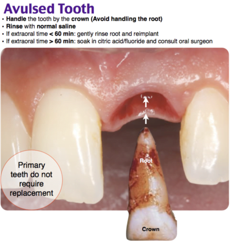 Close-up of a person's teethDescription automatically generated