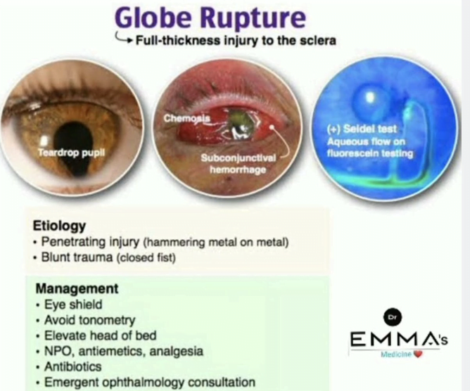 Eyeball and eyeball with labelsDescription automatically generated with medium confidence