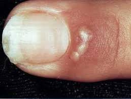 Herpetic Whitlow — DermNet