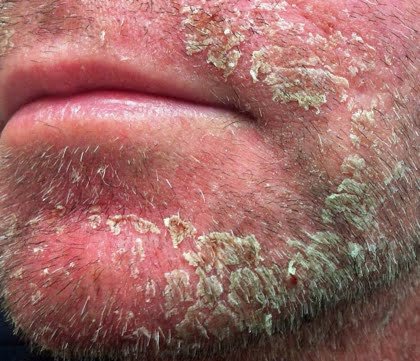 <div>Photograph credit: David H. Spach, MD</div>