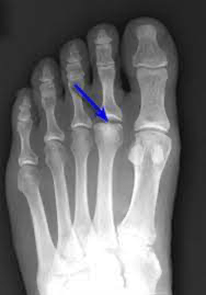 X-ray of a foot with a blue arrowDescription automatically generated