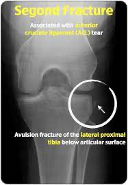 X-ray of a knee jointDescription automatically generated