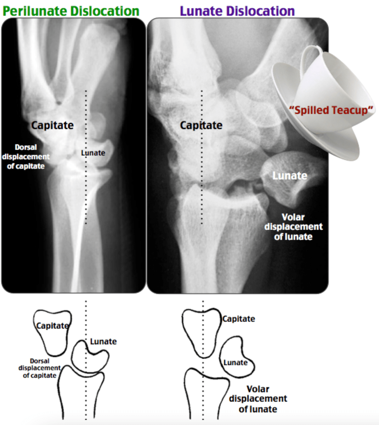 X-ray of bones and a cupDescription automatically generated